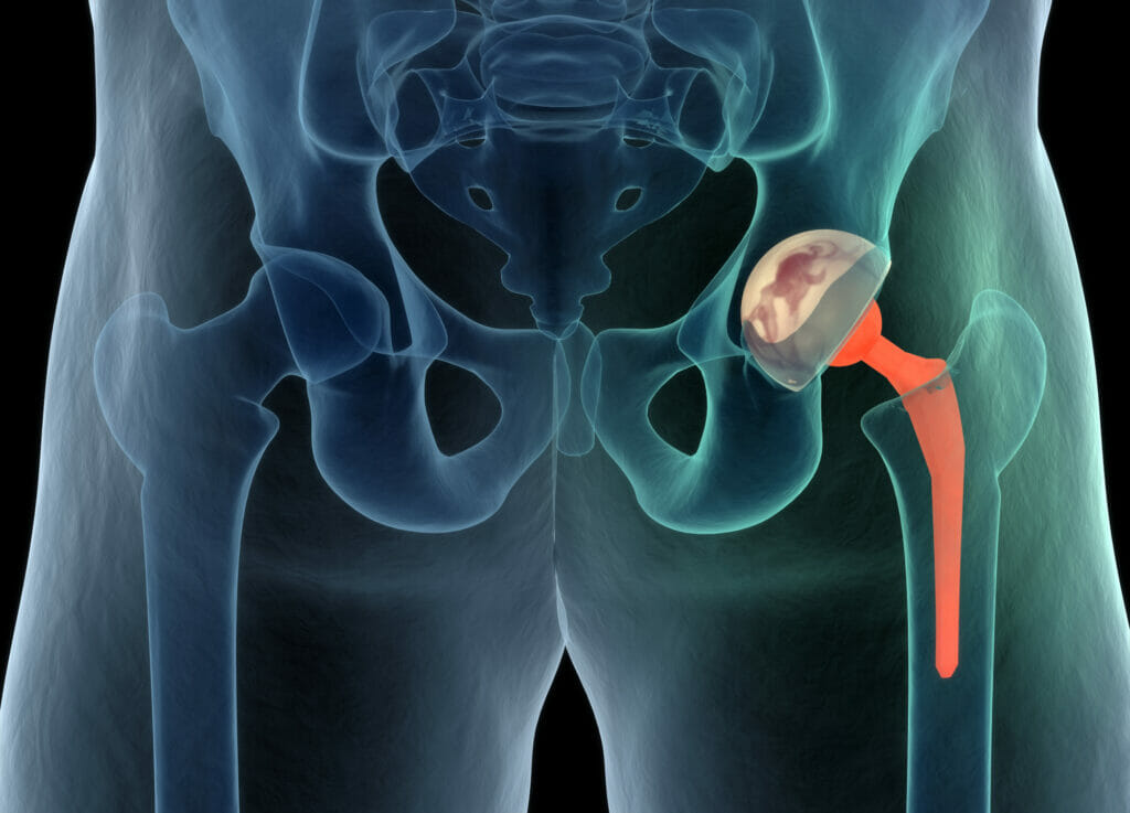 Medically accurate illustration of the hip replacement. 3d illustration.