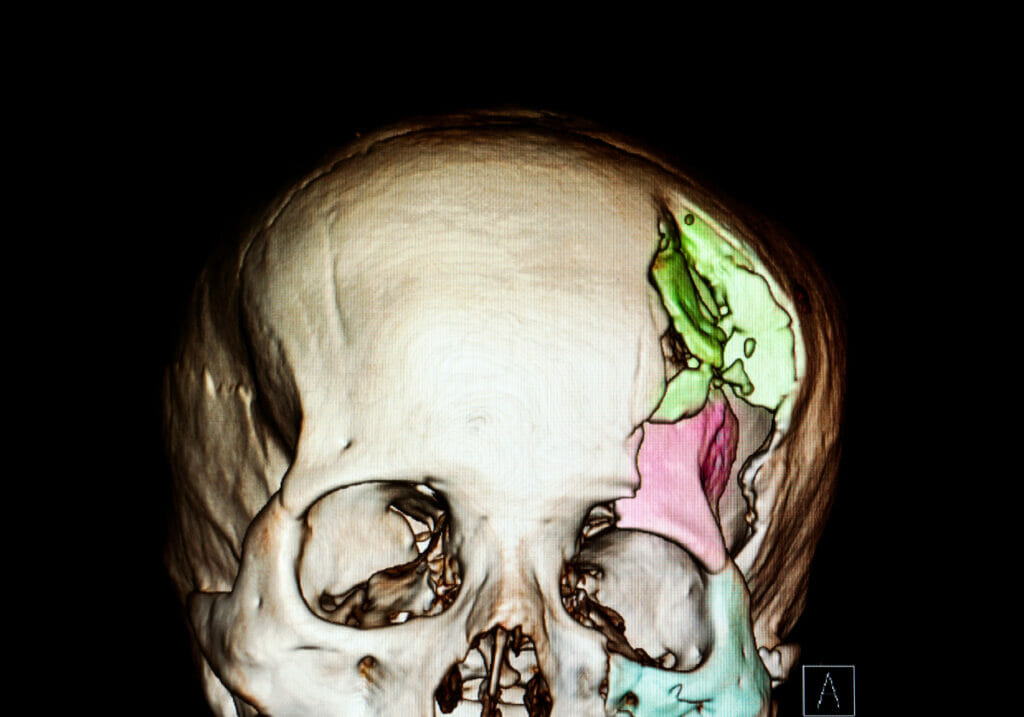 Xray showing fractured skull after injury