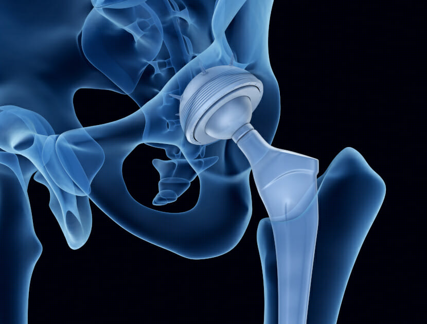 xray of Failed Biomaterials Hip Replacement
